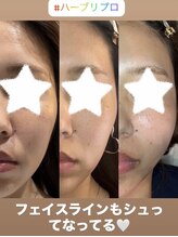 リツイート(ReTweet)/ハーブピーリング・艶・くすみ