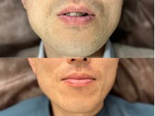 メンズ脱毛サロン ボス(BOSS)/ヒゲ剃り卒業！＃シェービング