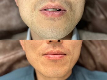 メンズ脱毛サロン ボス(BOSS)/ヒゲ剃り卒業！＃シェービング