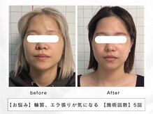 レッド(RED)の雰囲気（レモンボトル×RFリフトでフェイスライン爆誕！人気No.1メニュー）