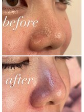 ニコ(nico)/毛穴/皮脂詰まり/角栓/ザラつき