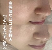 プラセル(Placer)