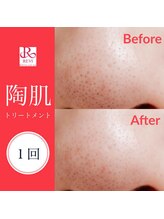 男前製作所 ナゴヤ(NAGOYA)/REVI（ルヴィ）ハーブピーリング