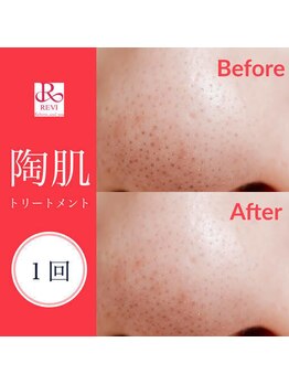 男前製作所 ナゴヤ(NAGOYA)/REVI（ルヴィ）ハーブピーリング