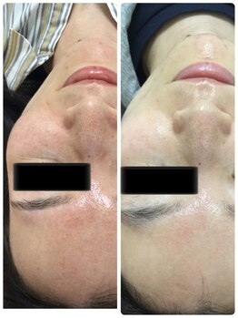 メイユール(MEILLEUR)/光フェイシャル3回