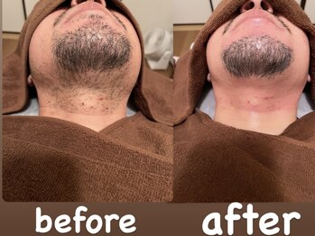 ソーレエルーナ(SOLE e LUNA)/ヒゲ デザイン ワックス 脱毛