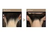 New当店人気【コラーゲン脱毛】うなじ美人　　13200円→6600円　お試し価格