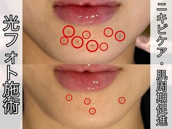 ヴィオール 名古屋栄店(VIOR)/光ショット施術　肌周期短縮！