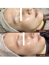 ネリネ(Nerine)/光フェイシャル