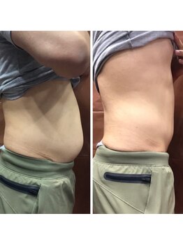 エスポワール/すごい効果の痩身機器キャビZERO