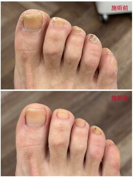 レフス 北参道店(REFUSS)/爪の変形/スケーリング