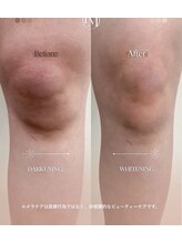 エルビービュティーサロン(LB BEAUTY SALON)/【ルメラ乳輪】実績数関西1★