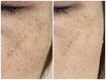 アンヘル(Angel)/ハーブトリートメント