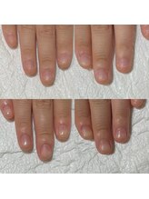 セラキュアネイル(Theracure nail)/3週間経過した看護師さんの爪