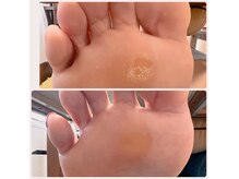 リアン(Re:an)の雰囲気（フットケア before/after）