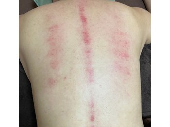 パピヨン(papillon)/かっさ背中