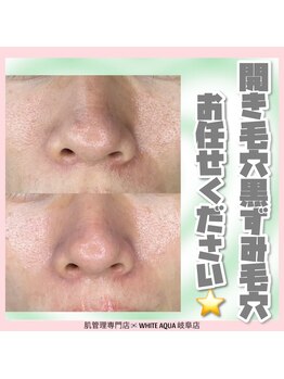 ホワイトアクア 岐阜店(WHITE AQUA)/ハーブピーリング/岐阜/毛穴