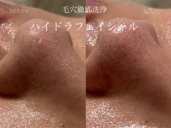 キアラ(CHIARA)/ハイドラフェイシャル