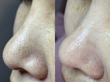 エミュ(emu)/毛穴ケア♪