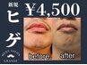 【ご新規様限定★】ヒゲ脱毛￥4500 #メンズ脱毛