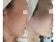 トリートメントルーム フェリーチェ(Felice)の写真/本気で肌を変えたい40代50代へ。ハーブピーリングで素肌力を高め、毛穴レス・ハリ艶あふれる美輪郭へ◎