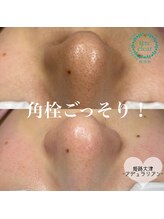 アデュラリアン(Adularian)/毛穴エクストラクション