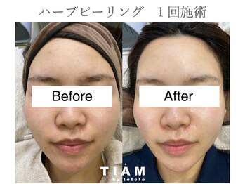 ル ポム バイ ティアム 神戸元町(Le pom by TIAM)/ハーブピーリング