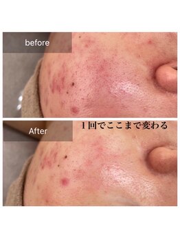 アルゴ 八幡黒崎店(ALGO)/ニキビケア、毛穴開き気になる方