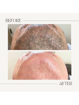 スプランドゥール(Splendeur)/メンズ【ひげ】WAX+光