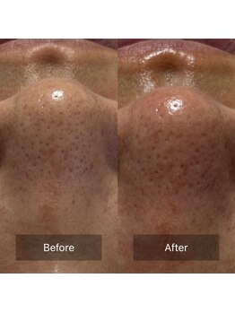 マヴィ(Mavie)/韓国式3D毛穴洗浄　