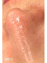 ドクターエイチ 四ツ橋堀江店(Doctor.H)/ハイドロ＋無針水光注入