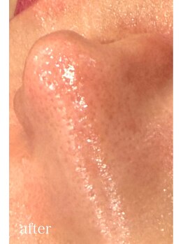 ドクターエイチ 四ツ橋堀江店(Doctor.H)/ハイドロ＋無針水光注入