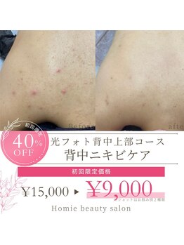 ホーミー(Homie)の写真/ブライダルや夏に向けて徹底肌質改善したい方必見!!【光フォト背中上部¥9000】背中ニキビが気になる方に◎