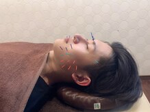 整骨院鍼灸院アシスト/メンズ美容鍼