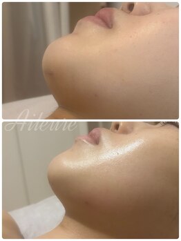 エルール トータルビューティ(Aileure total beauty)/ダウンタイムケアフェイスライン