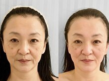 エスツリービューティーアンドネイル(S-TREE BEAUTY&NAIL)/【美白】ビフォーアフター1