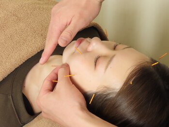 みずえ駅ビル整骨院の写真/【初めての方も◎】全身鍼灸・鍼・美容鍼、悩み別で選択。肩こり/眼精疲労にはショート鍼30分がおすすめ