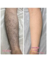 ベルフィーヌボーテ(BELFINE beaute)/メンズ脱毛