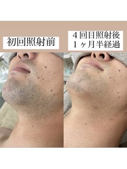 テンパ ビューティー(+10%beauty)/効果写真