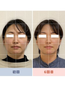 サロン ド フェルーチェ(salon de Feluce)/小顔矯正