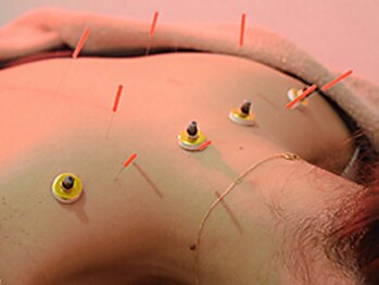 戸苅はり灸整骨院の写真/肩こり/不眠/頭痛etc..症状の根本原因に働きかけツボに鍼と灸を用いてアプローチ『健康寿命を１００歳へ』