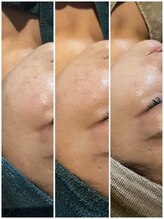 ベルーチェ(Beluce)/20代女性/ニキビケア　5回施術