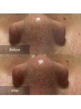 マヴィ(Mavie)/韓国式3D毛穴洗浄　