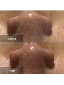 マヴィ(Mavie)/韓国式3D毛穴洗浄　