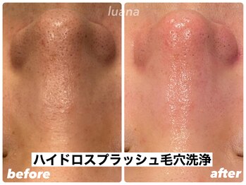 ルアナ(Luana)/脱☆イチゴ鼻