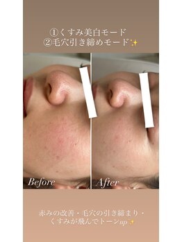 グランドシャルムエス(Grand Charme S)/赤ら顔には光フォト♪