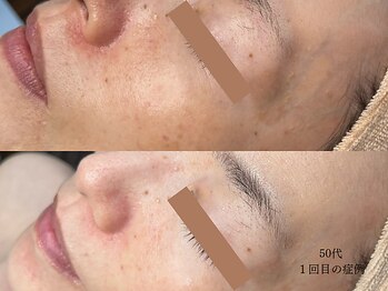 リボーン 柏(REBORN)/柏で話題くすみケアフェイシャル