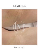 エルビービュティーサロン(LB BEAUTY SALON)/【ルメラ乳輪】実績数関西1★