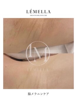 エルビービュティーサロン(LB BEAUTY SALON)/【ルメラ乳輪】実績数関西1★