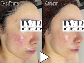 ラヴレボーテ(La Vraie Beaute)/30代・赤み敏感・改善期間13ヶ月